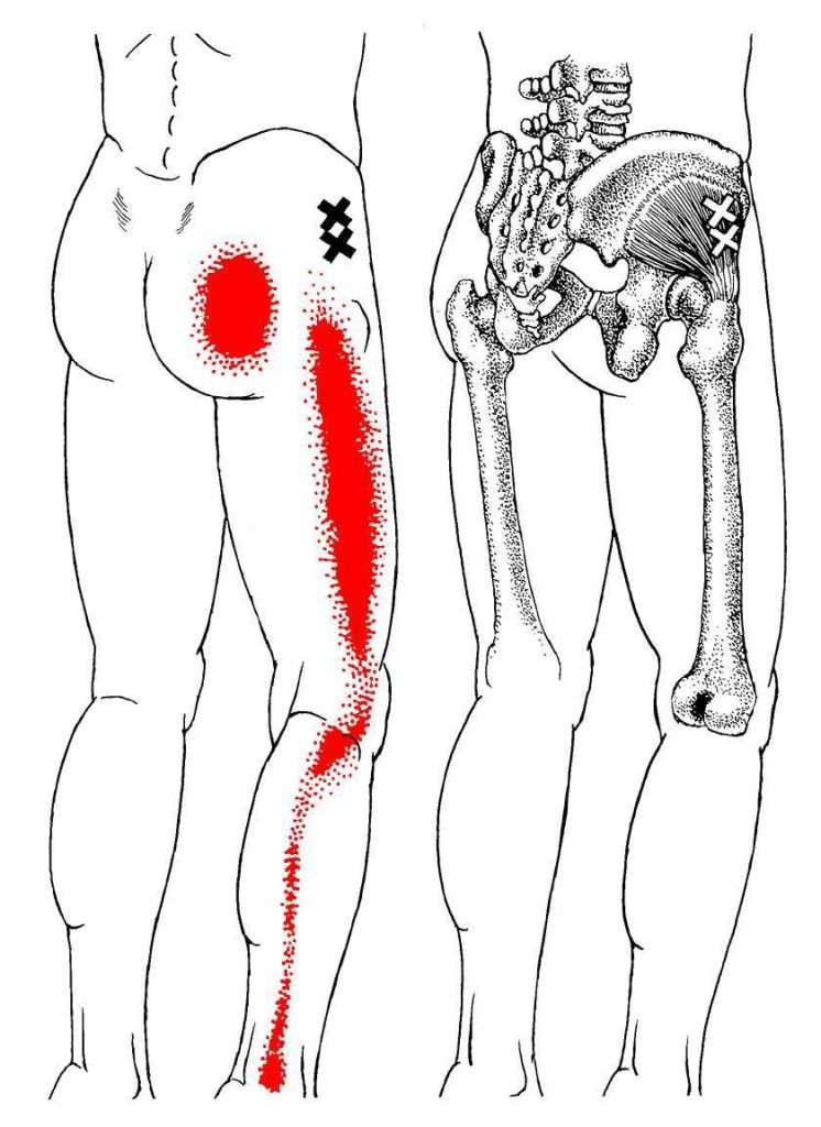 Glute Femur Attachment TrP