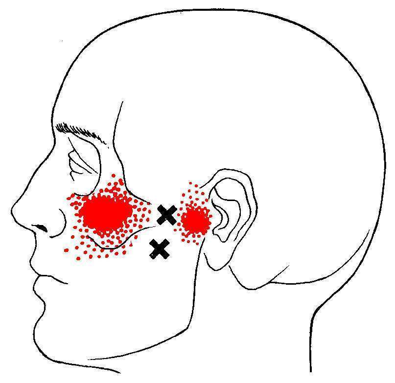 Lateral Pterigoid TrP