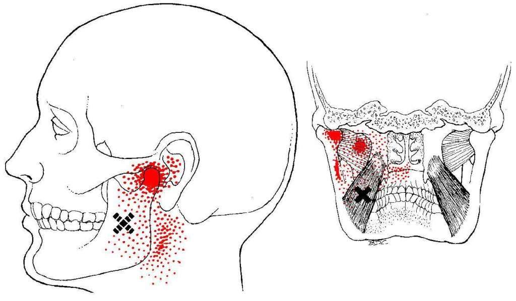 Medial Pterigoid TrP