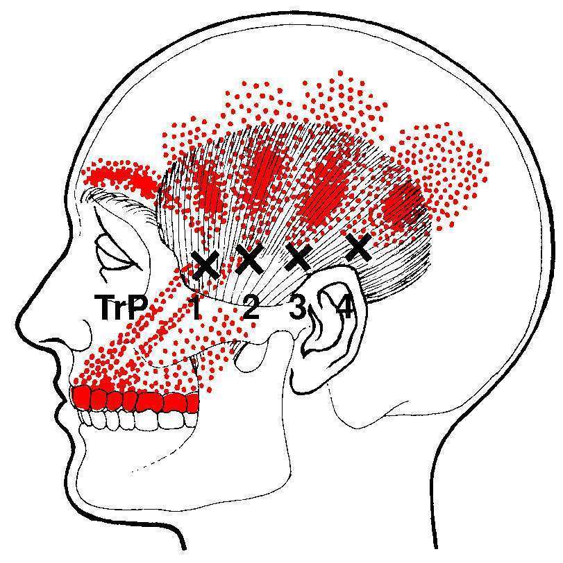 Temporalis TrP