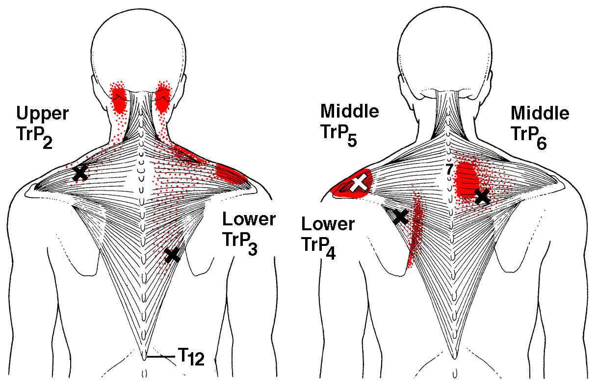 Trapezius TrP